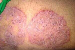 5bbb7a96 jamur kulit